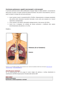 Carcinoma polmonare: aspetti macroscopici e microscopici Cancro
