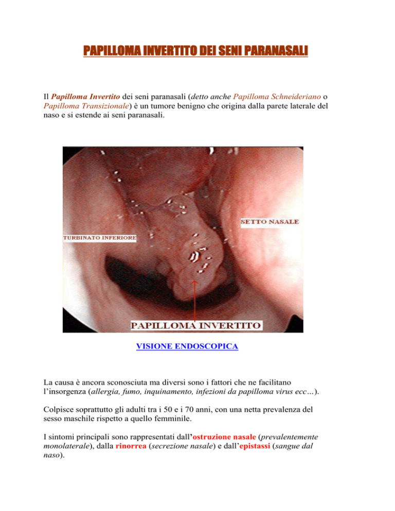 Papilloma inverso nasale. Papilloma invertito naso sintomi