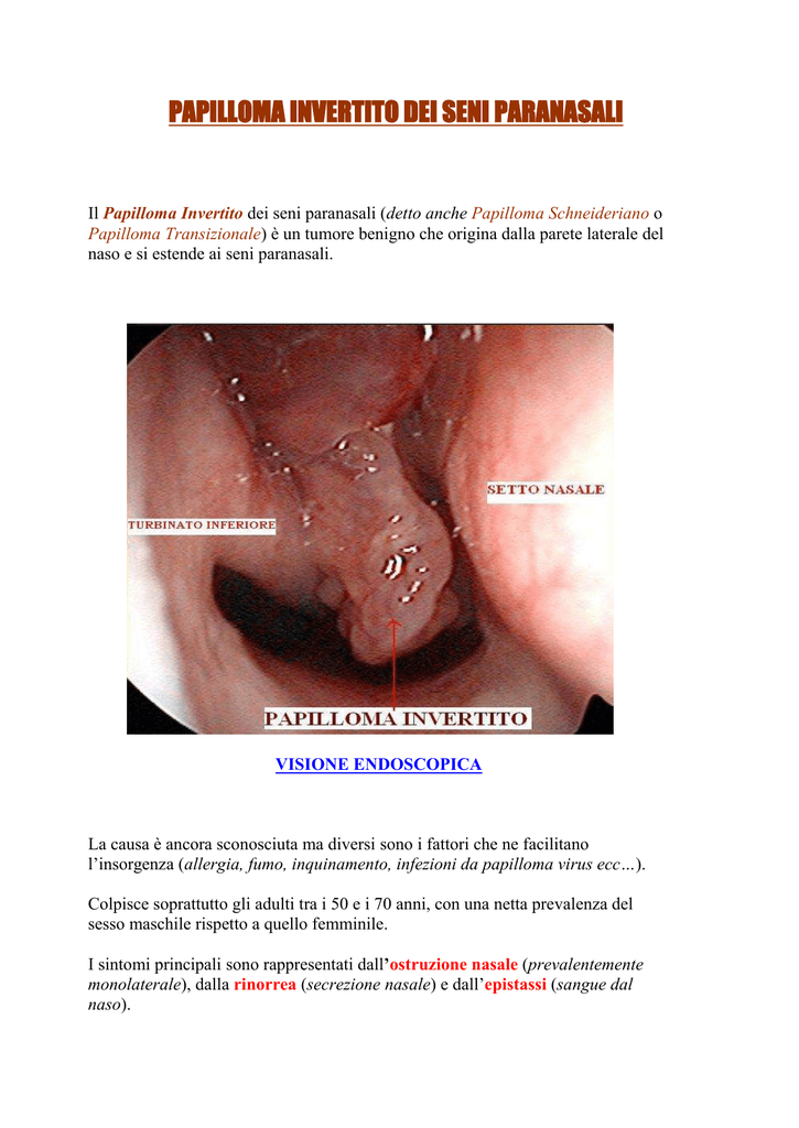 papilloma nasale sintomi