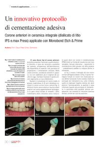 Un innovativo protocollo di cementazione adesiva