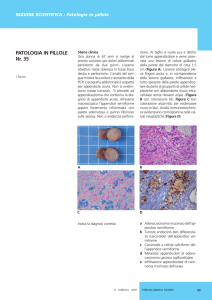 Barizzi J,Carcinoide a cellule caliciformi dell`appendice vermiforme