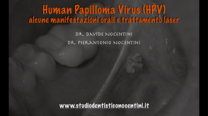 HPV- Alcune manifestazioni orali e trattamento laser